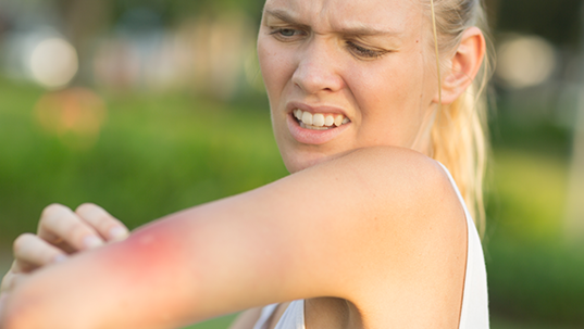 stinging insect bite